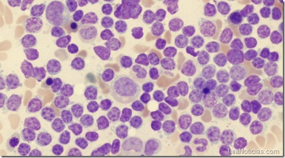 celulas_leucemia-595x328