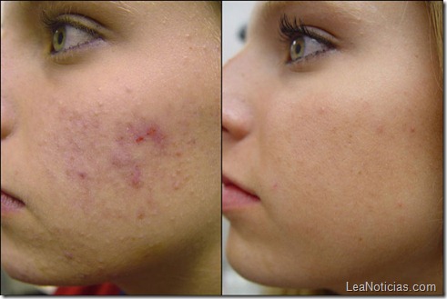 acne-no-more-treatment