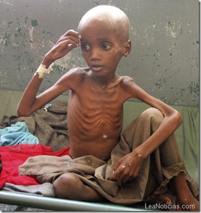 desnutricion-en-somalia