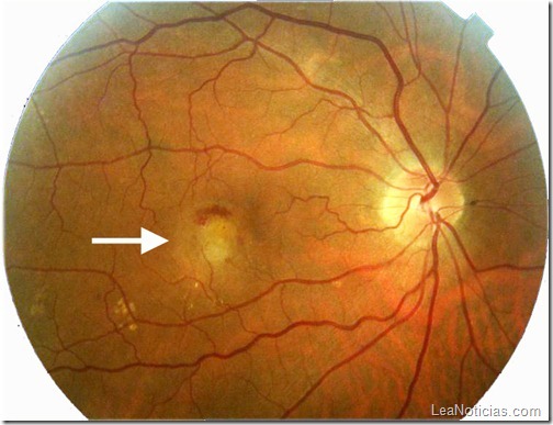 retinopatía-diabética-1