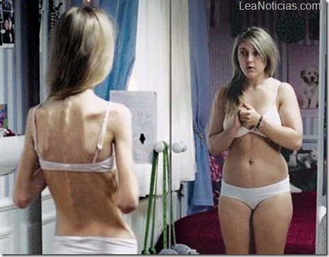 anorexia