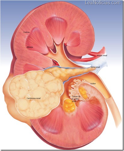 renal cancer renal cancer