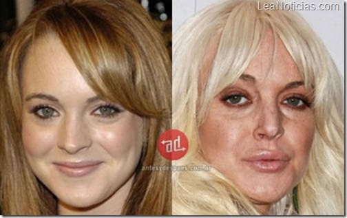 botox_Lindsay-Lohan_implants_www