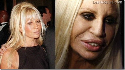 donatella-Versace-botox