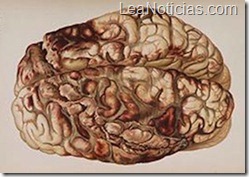 cerebro