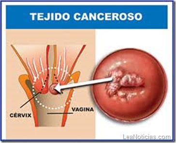 vagina-mujer-cancer