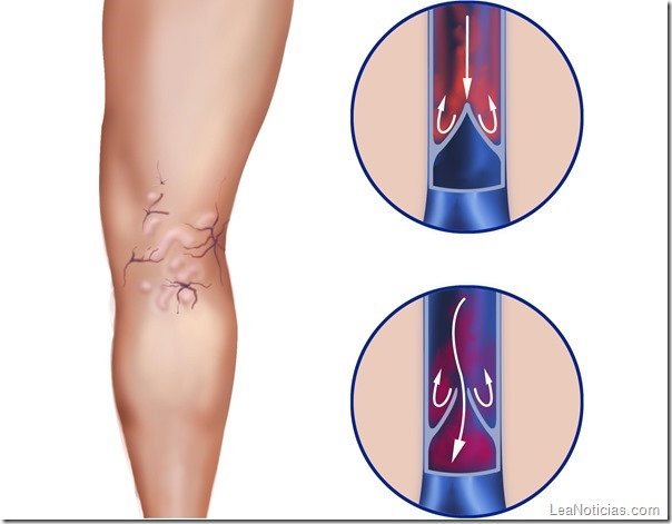 varices-como-disimularlas