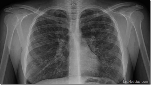 pulmones-radiografia-fibrosis