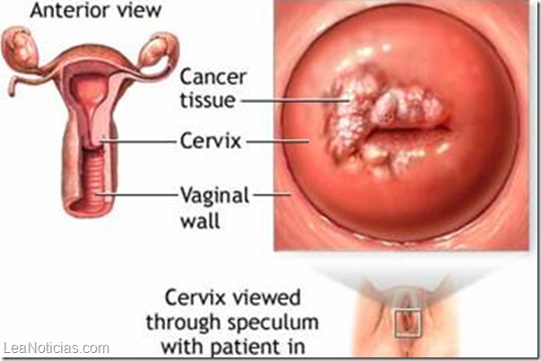 cancer uterino