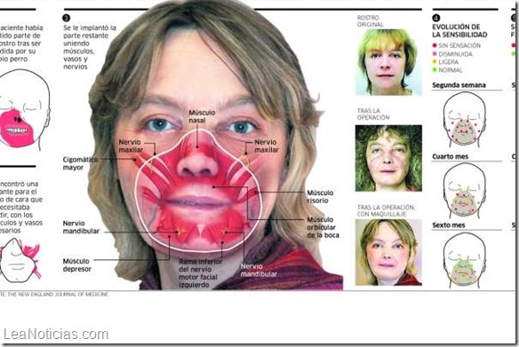 transplantecara