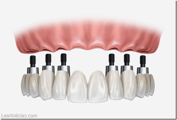 Protesis-dentales-fijas-sobre-implantes