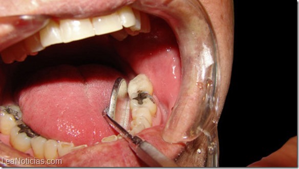 consumo azucar afecta dientes 1