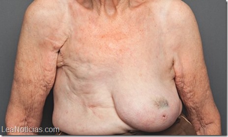 senos mastectomia
