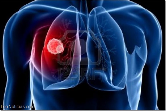 Cancer-de-pulmón-1-792x384