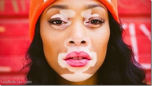 modelo-vitiligo3--644x362