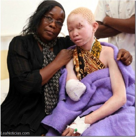 albinos tanzania 2