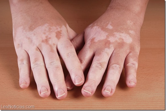 Tratamiento con nuevo láser da esperanza a pacientes que sufren de vitiligo