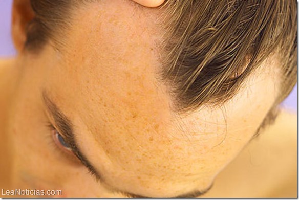alopecia androgenética