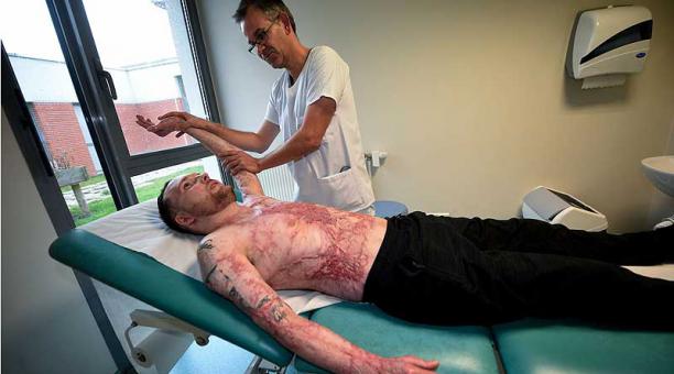 Un quemado sobrevive gracias al trasplante de la piel de su hermano gemelo