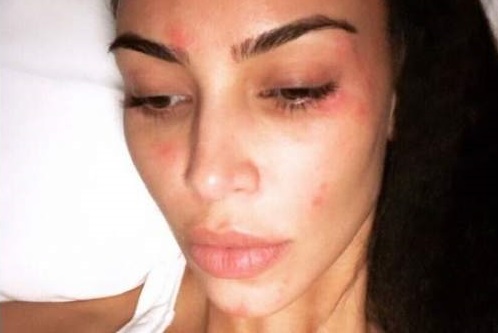 Kim hasta enferma bate récords en las redes: posó sin maquillaje para mostrar los efectos de la psoriasis de su cara