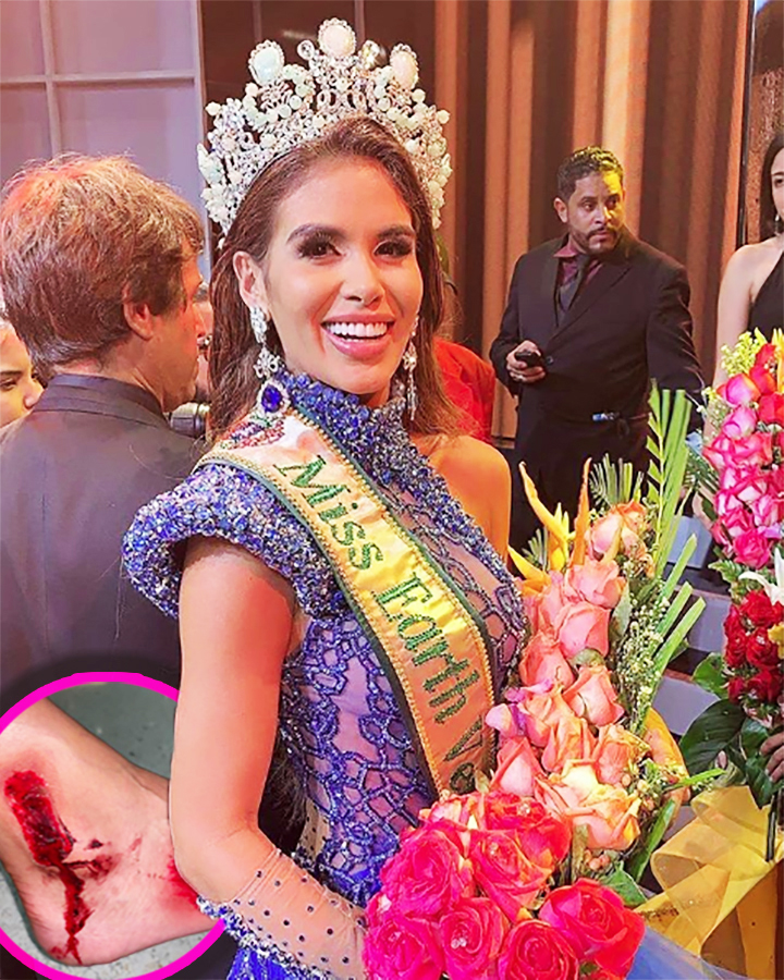 Miss Earth Venezuela dice la verdad y muestra las fotos del accidente que sufrió